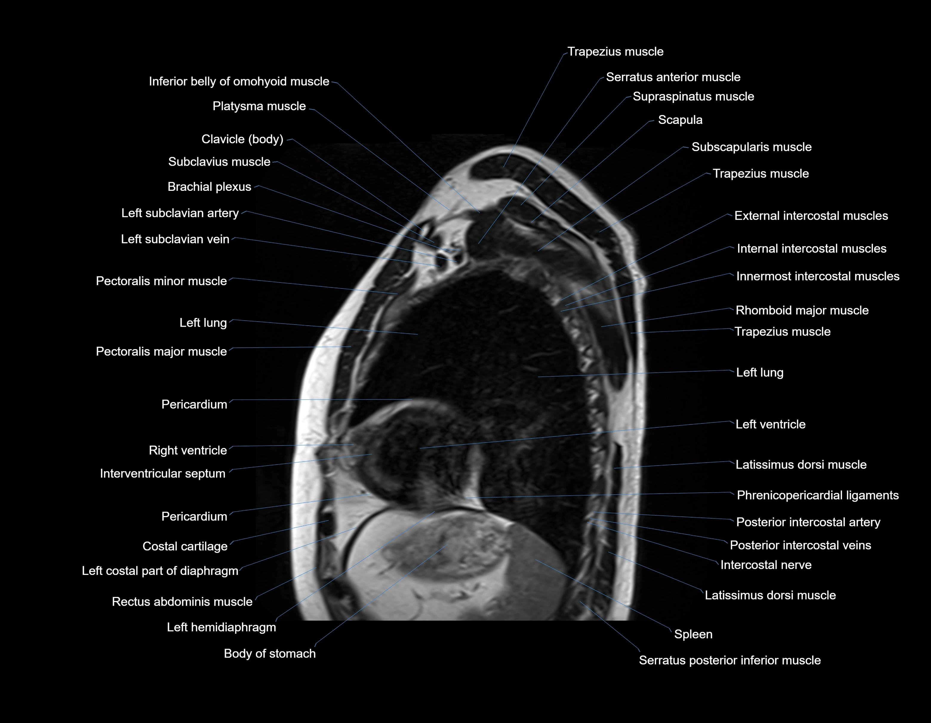 MRI chest (thorax) sagittal labelled cross sectional anatomy 3T radiology image-img-00001-00029.webp